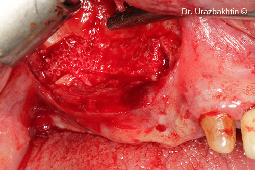 Augmentation using the inlay bone graft technique