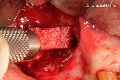 Augmentation using the inlay bone graft technique