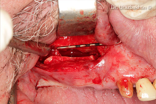 Osteotomy of the jaw ridge