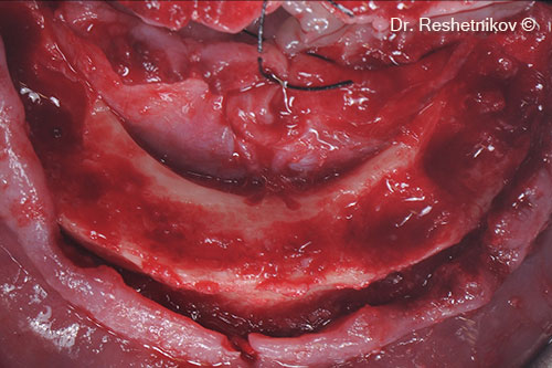 Skeletonization of soft tissues