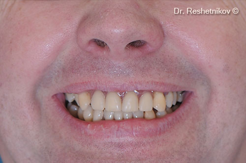 Patient complaints: mobility of teeth of both jaws, poor fixation of the removable denture, aesthetic dissatisfaction