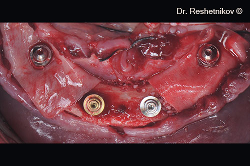 OsteoBiol® Evolution collagen membrane covers alveolar ridge defects on the lingual and vestibular sides; fixed around the installed abutments