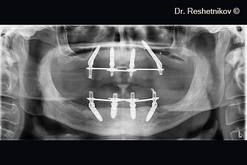 Panoramic radiograph on the day of surgery after immediate prosthetics with reinforced temporary plastic dentures on both jaws