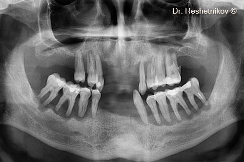 An orthopantomogram reveals the absence of bone tissue around the teeth roots. The edges of the alveolar ridge of the lower jaw are highlighted in blue