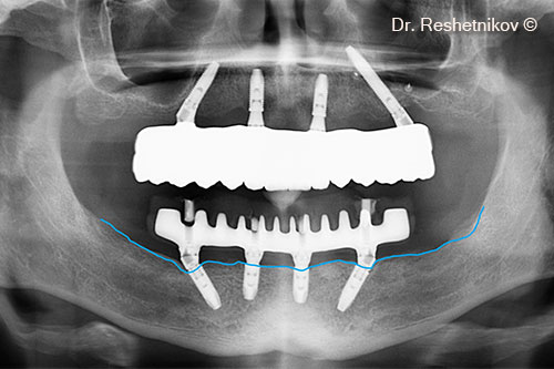 Panoramic radiograph after fixation of permanent dentures. High-quality restoration of alveolar bone with formation of cortical layer