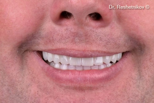 Smiling patient with installed permanent structures on implants