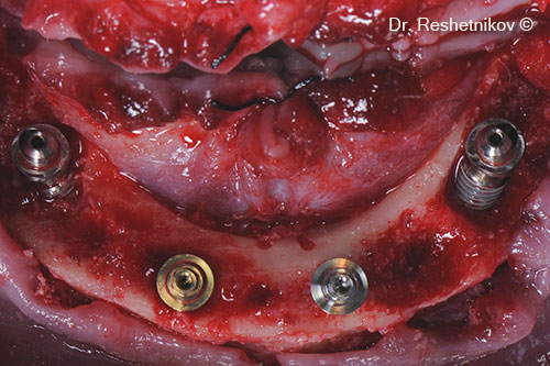 Implants installed using the “All-on-4” protocol. Multiple alveolar ridge defects and post-extraction sockets