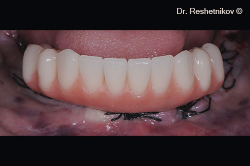 Sutures and immediate temporary implant prosthetics on the day of surgery