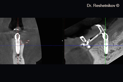 On the day of surgery, CBCT of the distal right implant