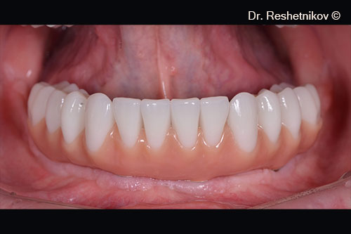 Fixation of permanent dentures 8 months after the start of treatment