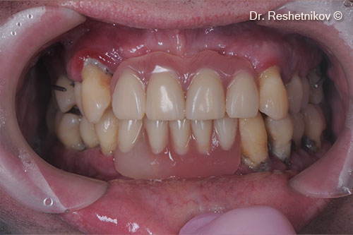 Patient complaints: mobility of teeth of both jaws, poor fixation of the removable denture, aesthetic dissatisfaction