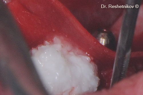 OsteoBiol® mp3® tightly packed around the installed implants