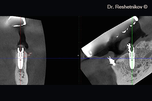 CBCT after 6 months. Restored bone volume around the distal right implant