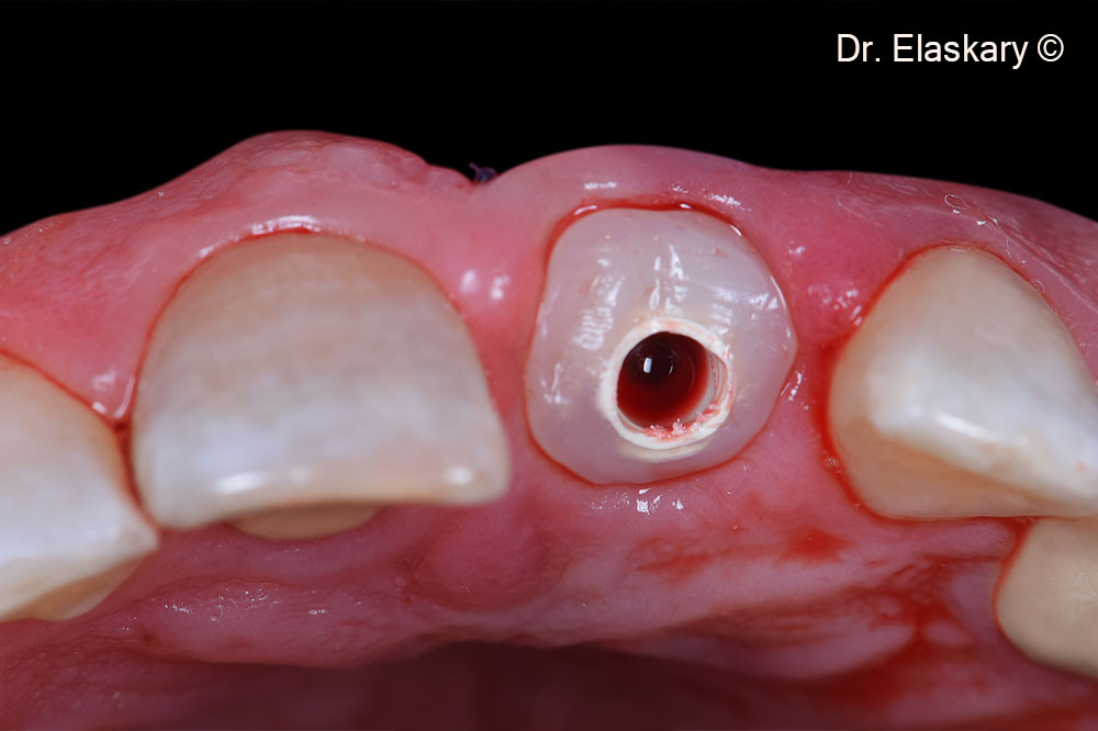 6. Customized healing abutment is fitted to preserve the original socket architecture and to cover the bone graft