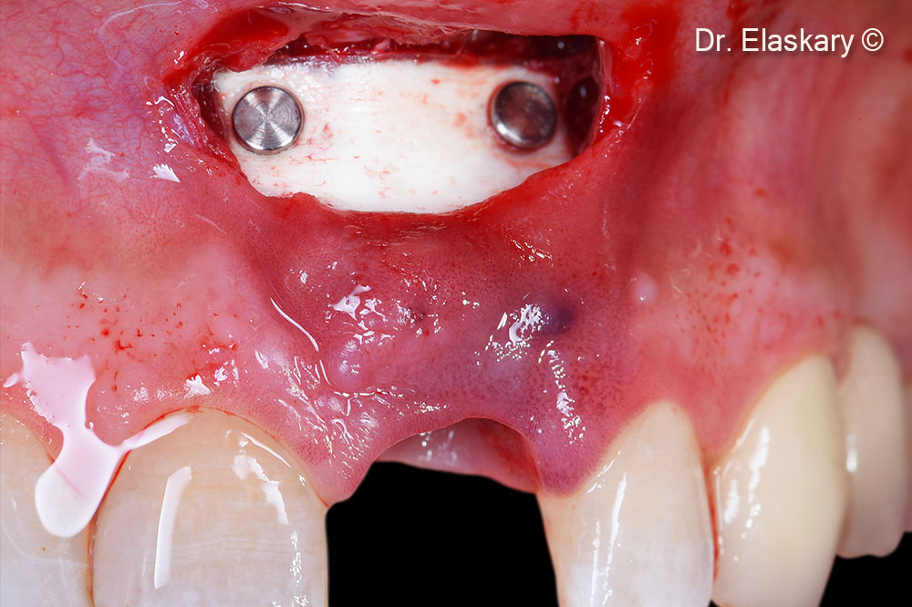 5. Soft Cortical Lamina 1 mm is stabilized using two membrane tacs apically