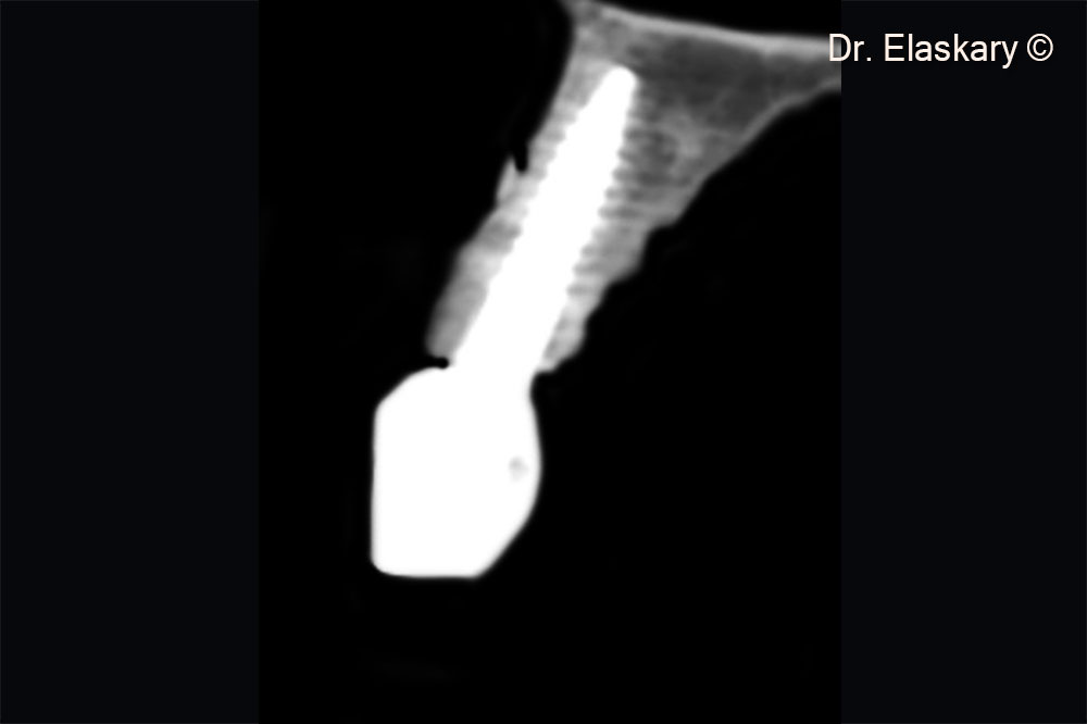 9. Two years post operative CBCT scan shows the regeneration of the labial plate of bone