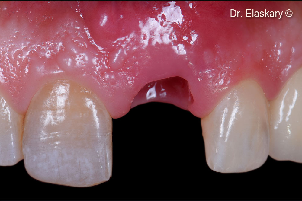 2. Frontal view of the location after the tooth is extracted and the socket debrided