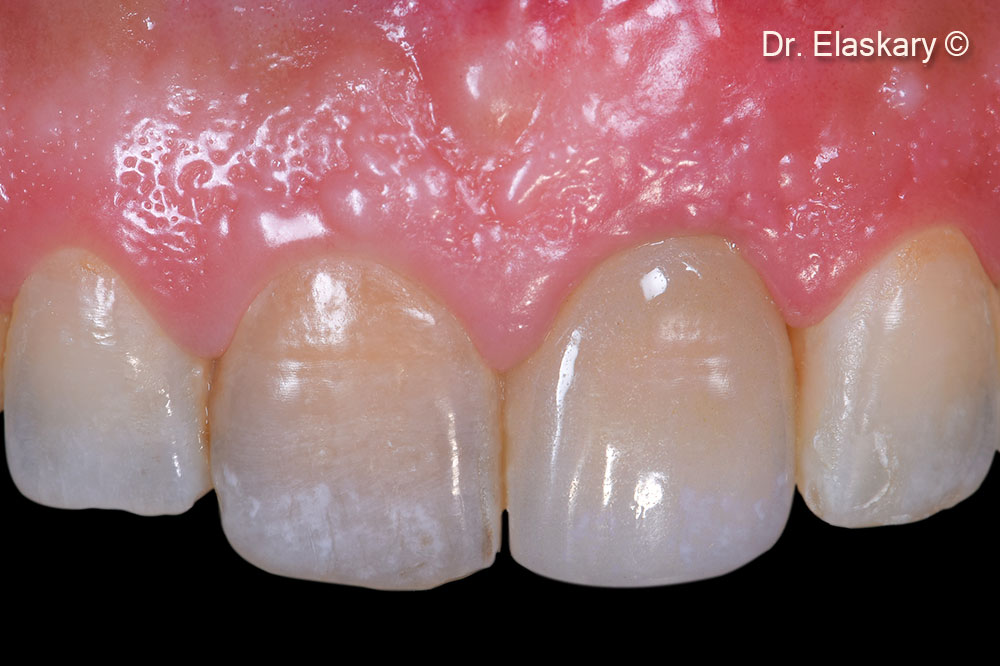 8. The final restoration in place shows a total restoration of the soft tissue margins