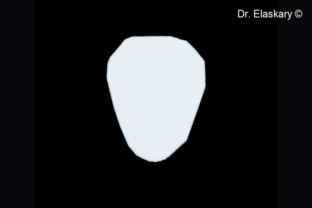 4. Soft Cortical Lamina 1 mm is trimmed to cover the osseous defect