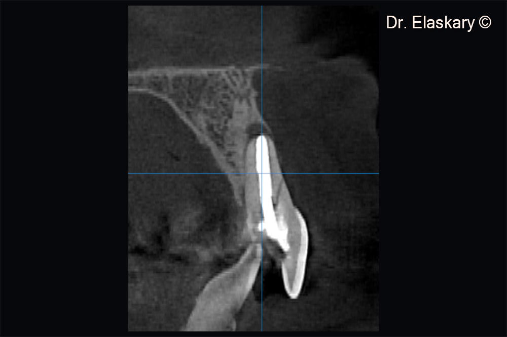 1. CBCT scan showing a sagittal section of broken central incisor , with lost labial plate of bone