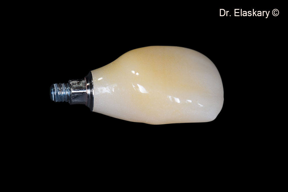 7. A screw retained zirconia crown is prepared