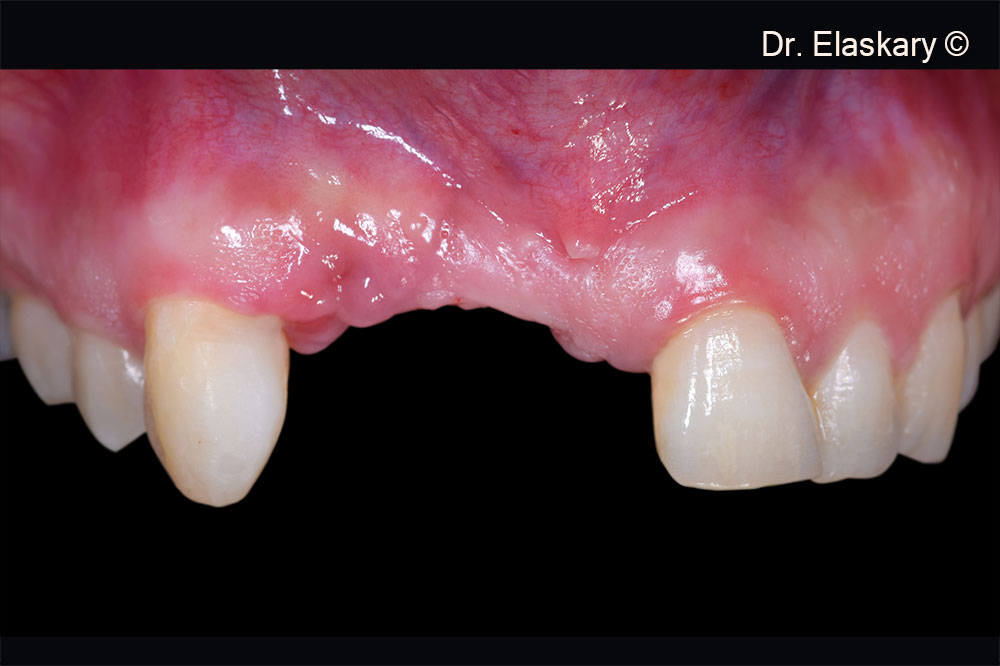 1. Pre operative frontal view of lost both vertical and horizontal anterior tissues related to the alveolar ridge