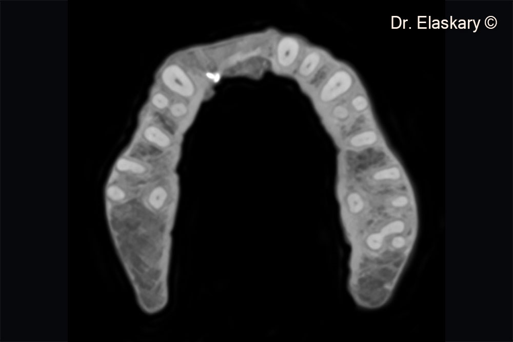 14. CBCT scan showing the total regeneration of the lost tissues.