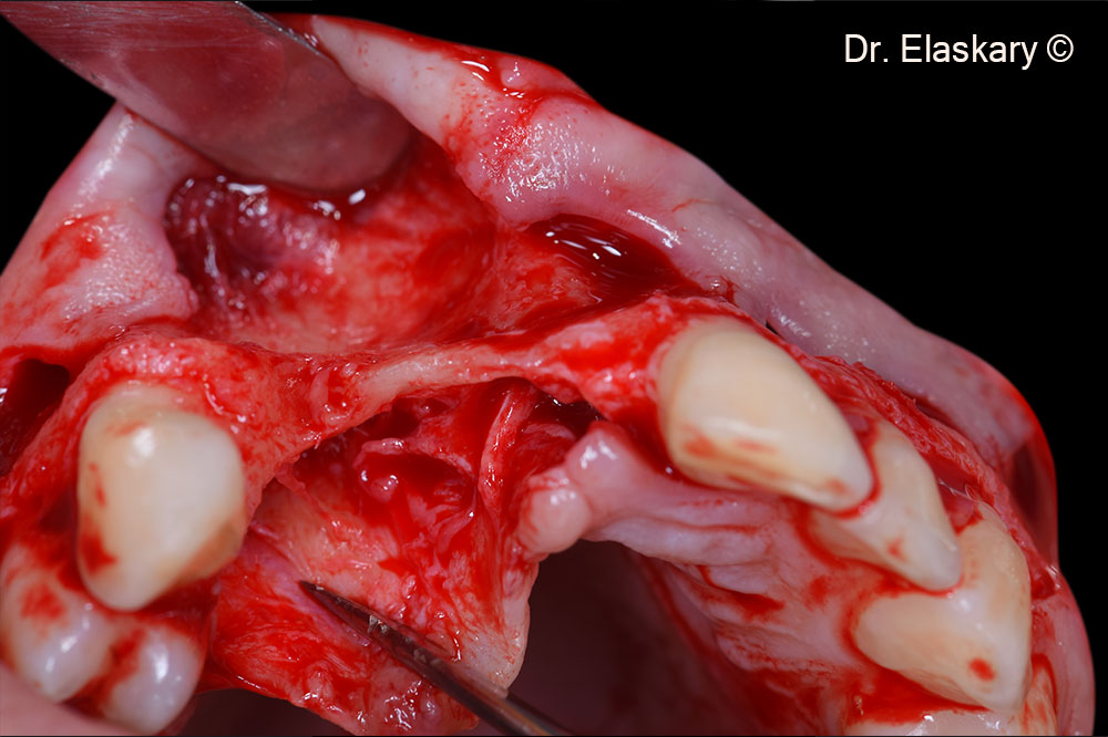 4. Intra surgical incisal  view showing the total loss of the osseous foundation related to the missing teeth