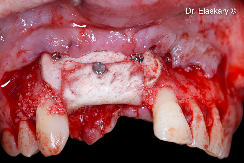 9. Soft Cortical Lamina is from the palatal to the labial side to protect the bone graft occlusally