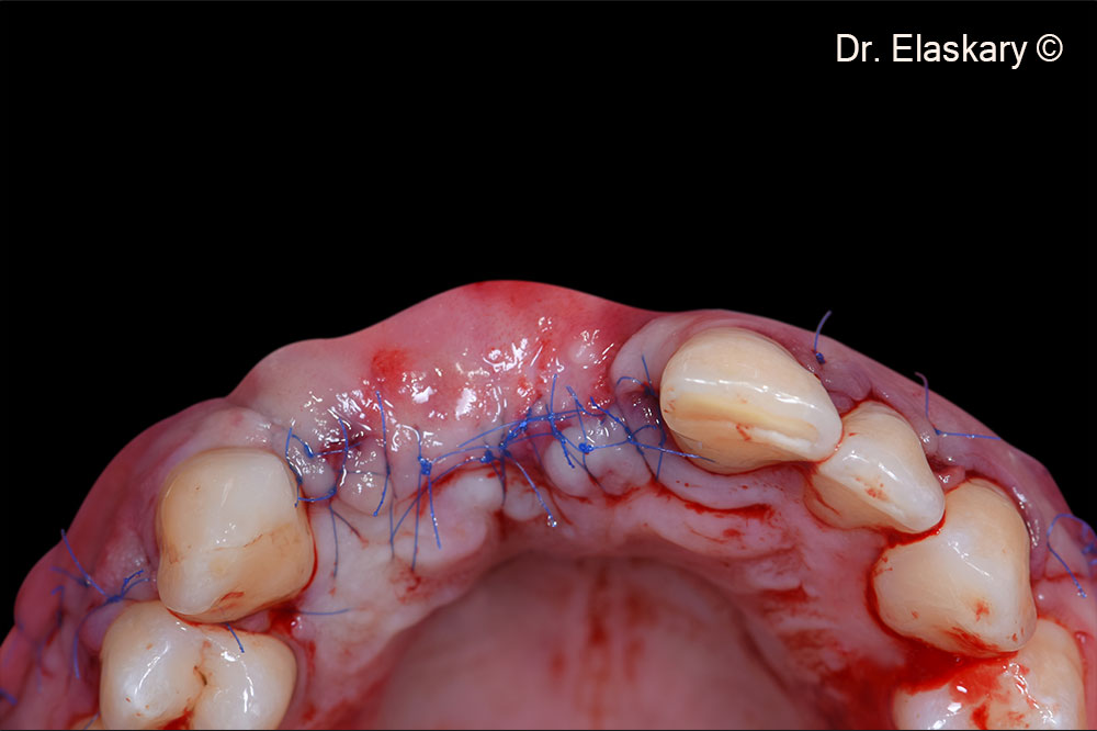 10. Incisal view showing  the flap released, extended and closed using 6-0 proline sutures. 