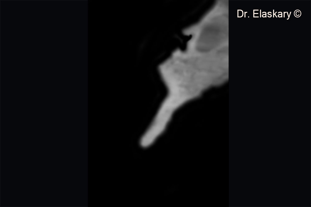 3. CBCT scan showing the loss of the buccal bone