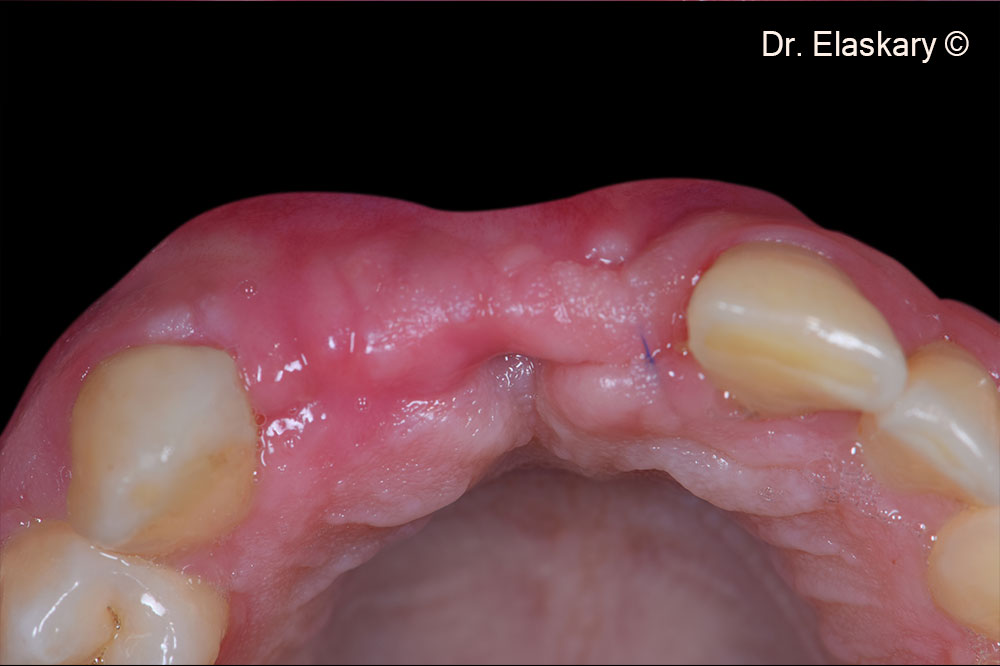 12. Incisal view showing  view showing  3 weeks post surgery showing a total tissue closure.