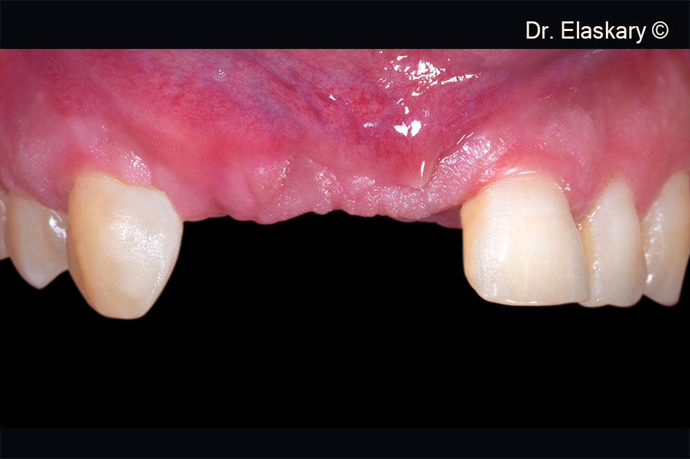 13. Frontal view showing  view showing  3 weeks post surgery showing a total tissue closure.