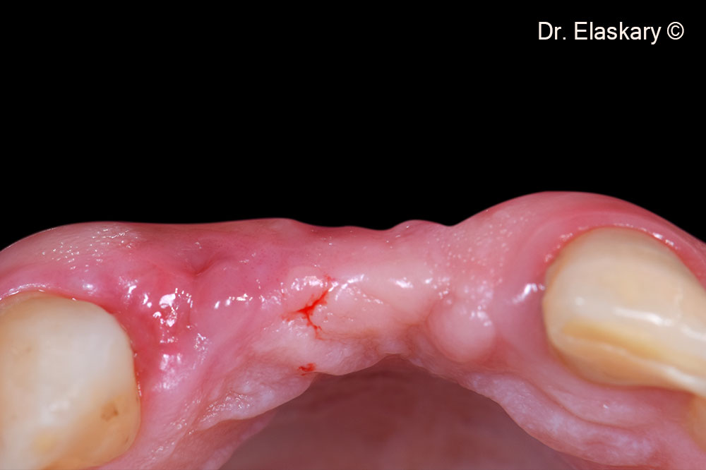 2. Pre operative incisal view of lost both vertical and horizontal anterior tissues related to the alveolar ridge