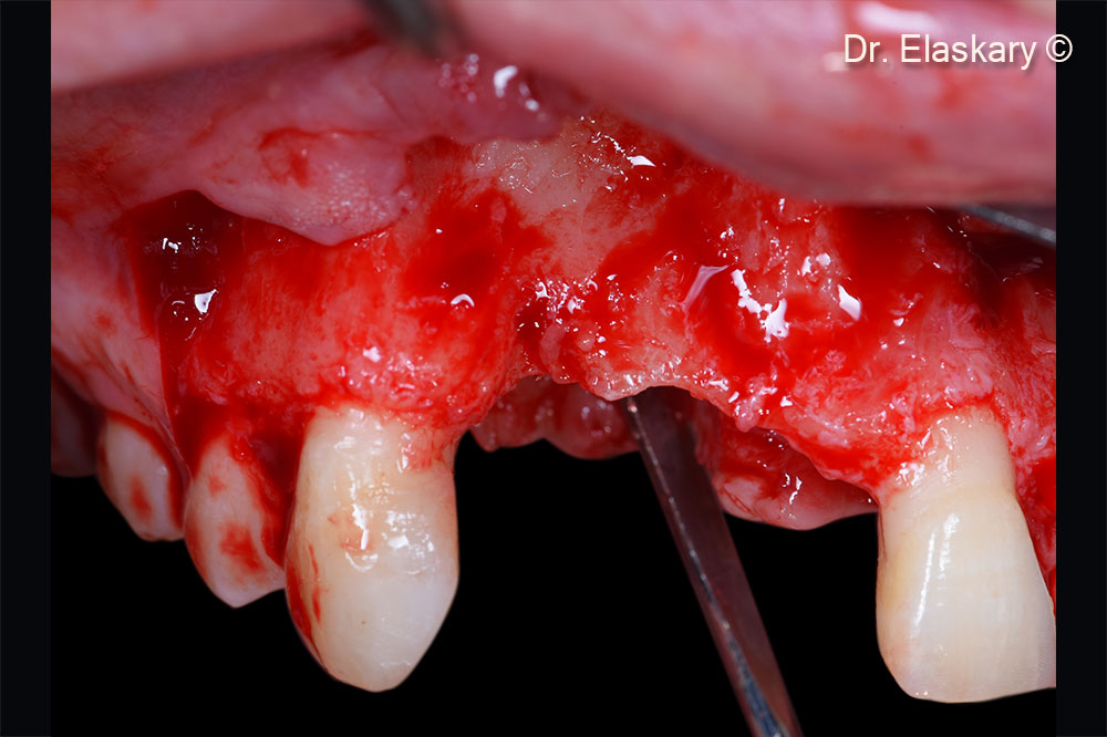 5. Intra surgical frontal view showing the total loss of the osseous foundation related to the missing teeth