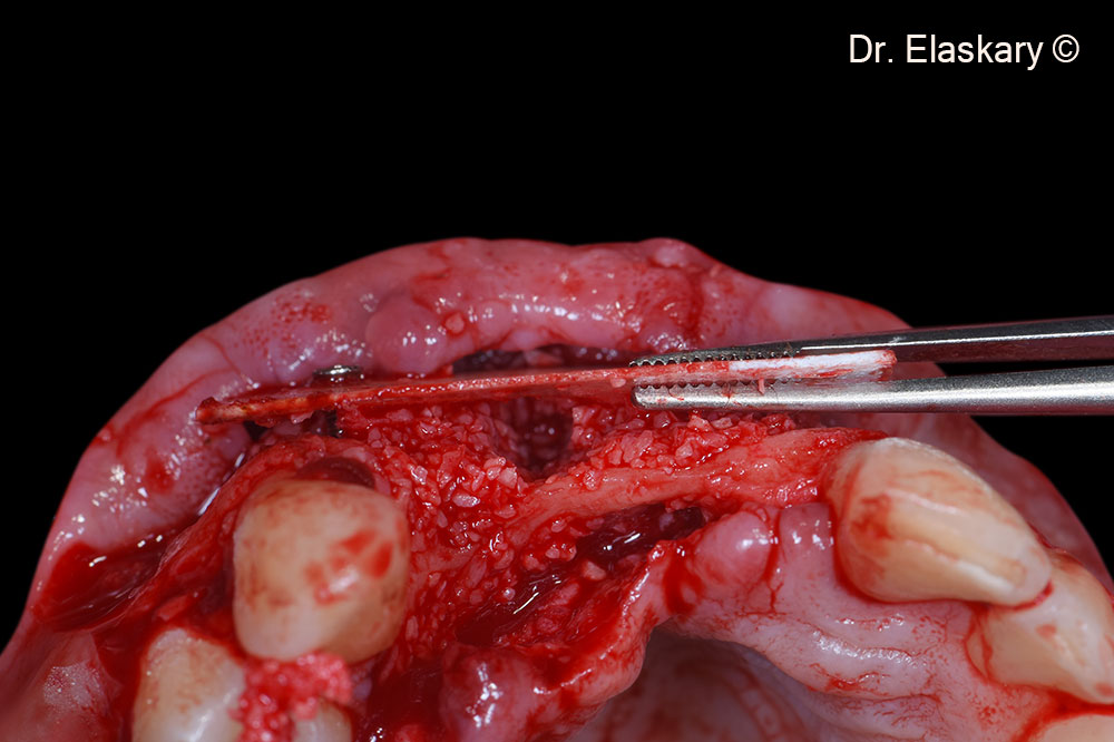 6. Soft Cortical Lamina was stabilized on top of the defect leaving the regenerative space underneath Gen-Os