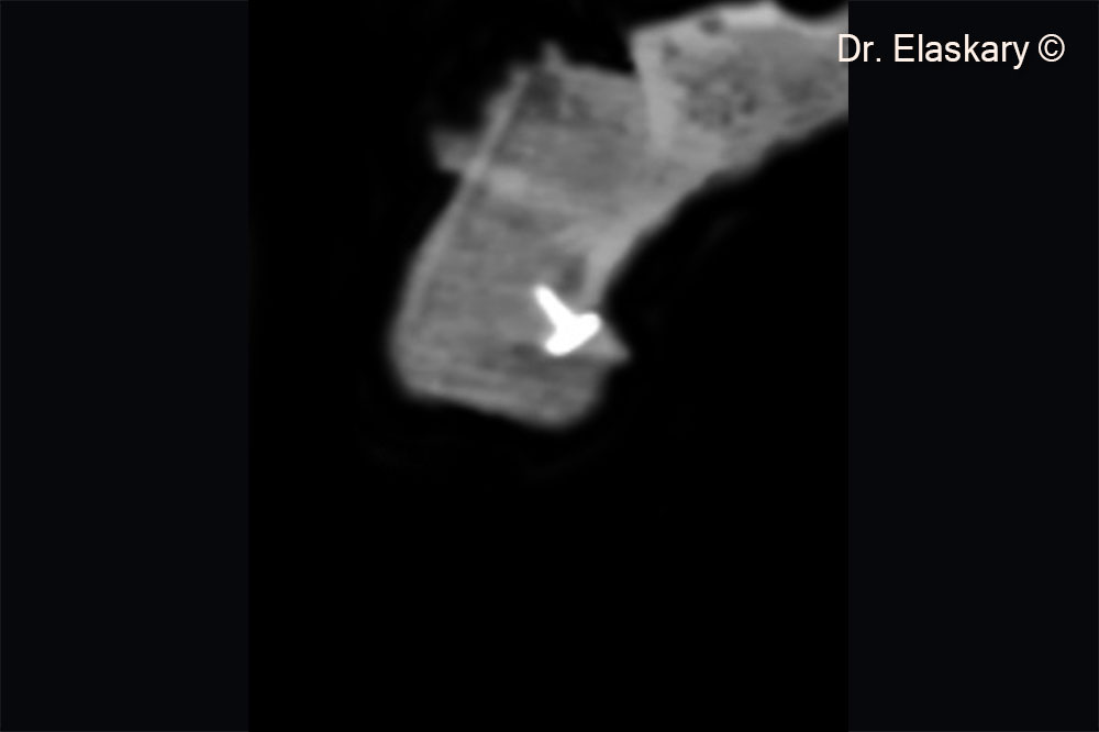 15. CBCT scan showing the total regeneration of the lost tissues.