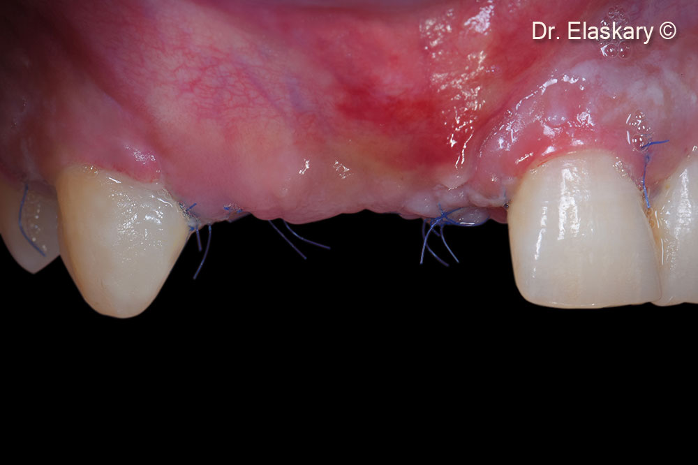 11. Frontal view showing  the flap released, extended and closed using 6-0 proline sutures. 